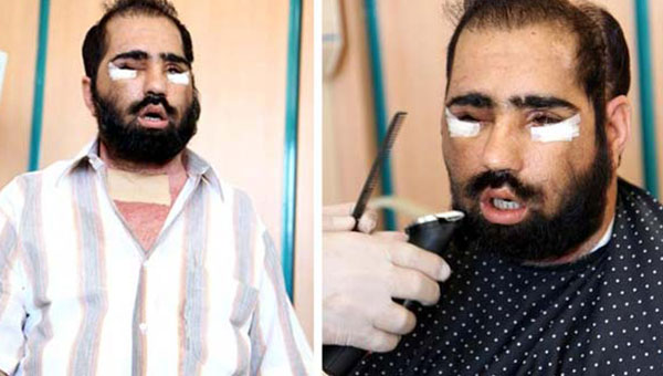 Yüz nakli yapılan Salih Üslün'den acı haber