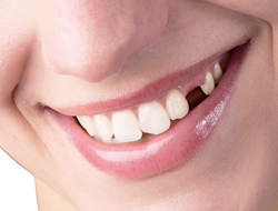 Eksik Dişi Olanlar Dikkat