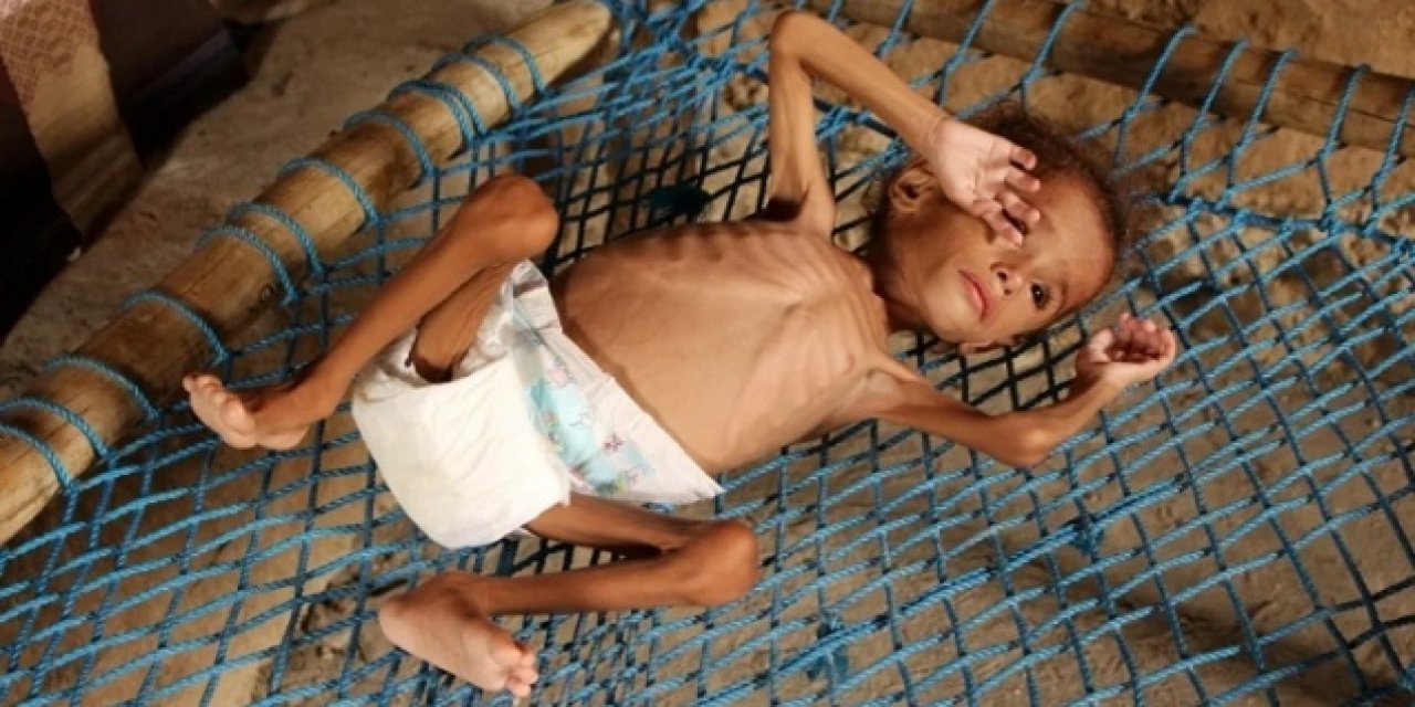 Uluslararası Göç Örgütü: "Yemen halkının yaklaşık üçte ikisi, sıtmadan etkilenen bölgelerde yaşıyor"