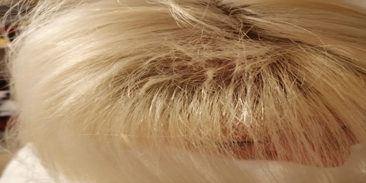 Kocaeli'de boyattıktan sonra saçları dökülen kadın avukat, kuaförden şikayetçi oldu