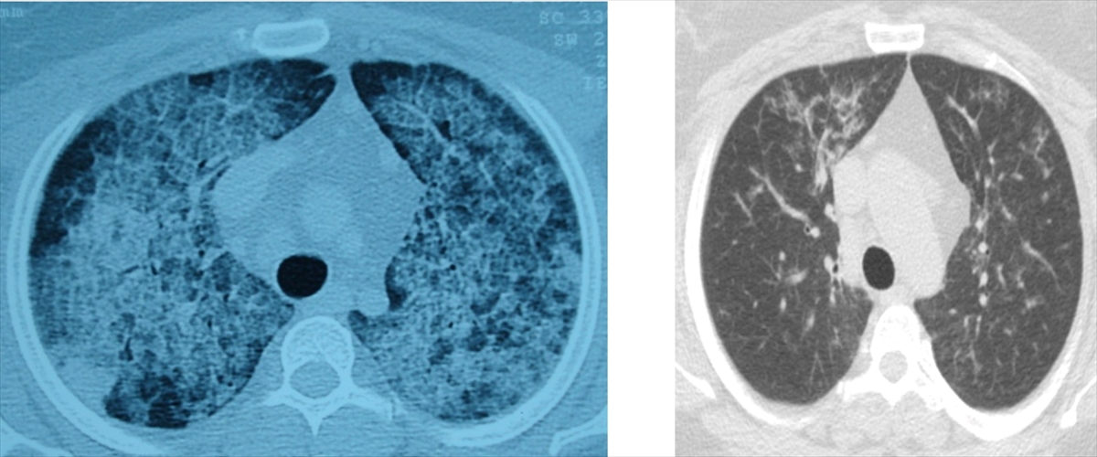 Akciğer yıkaması yöntemiyle hastalar yeniden rahat nefes alıyor