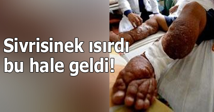 Sivrisinek Bir Isırdı ve...