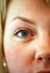 Gül Hastalığına Dikkat!