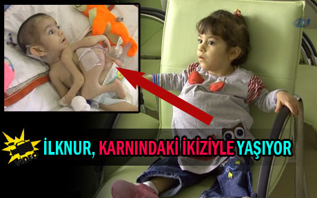 İkiziyle birlikte yaşıyor