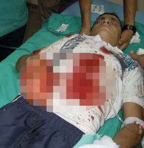 Bomba elinde patladı iki parmağı koptu!