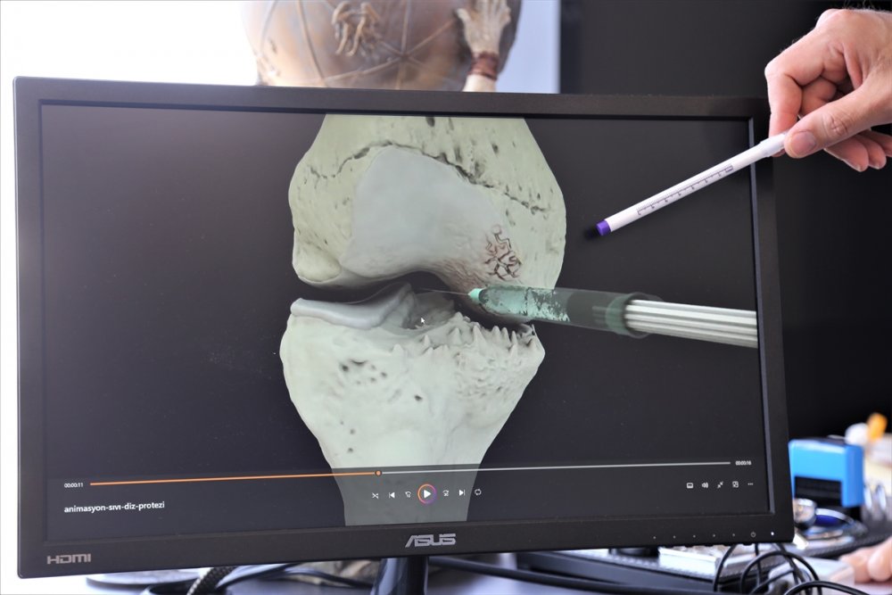 Diz kireçlenmelerine karşı ameliyatsız "hidrojel" uygulaması