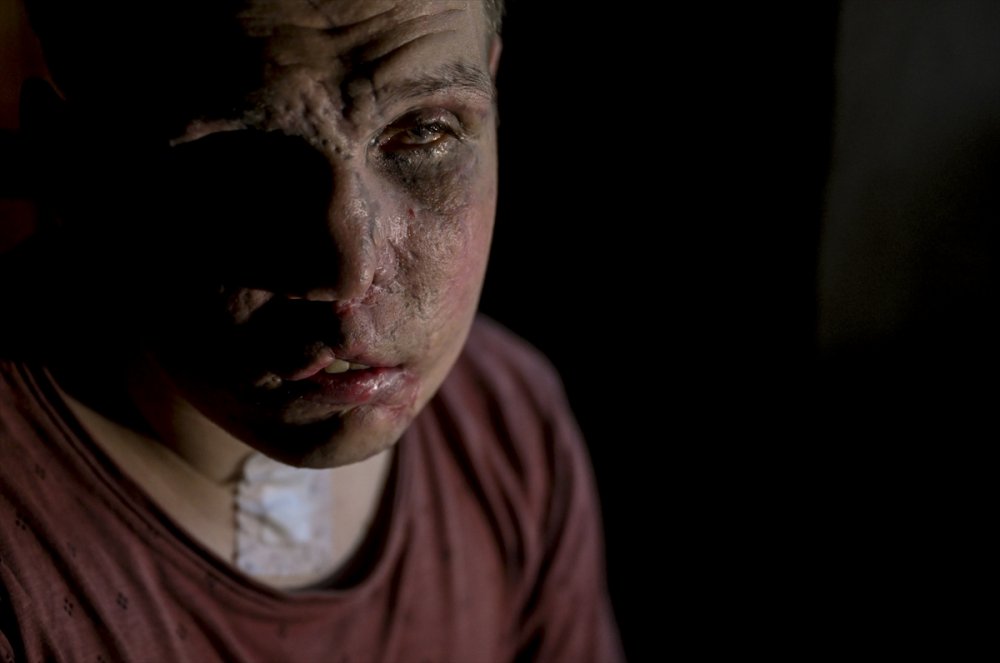 Ukrayna'daki savaşın acı yüzü: Gözlerini ve bacaklarını kaybeden Ukraynalı asker