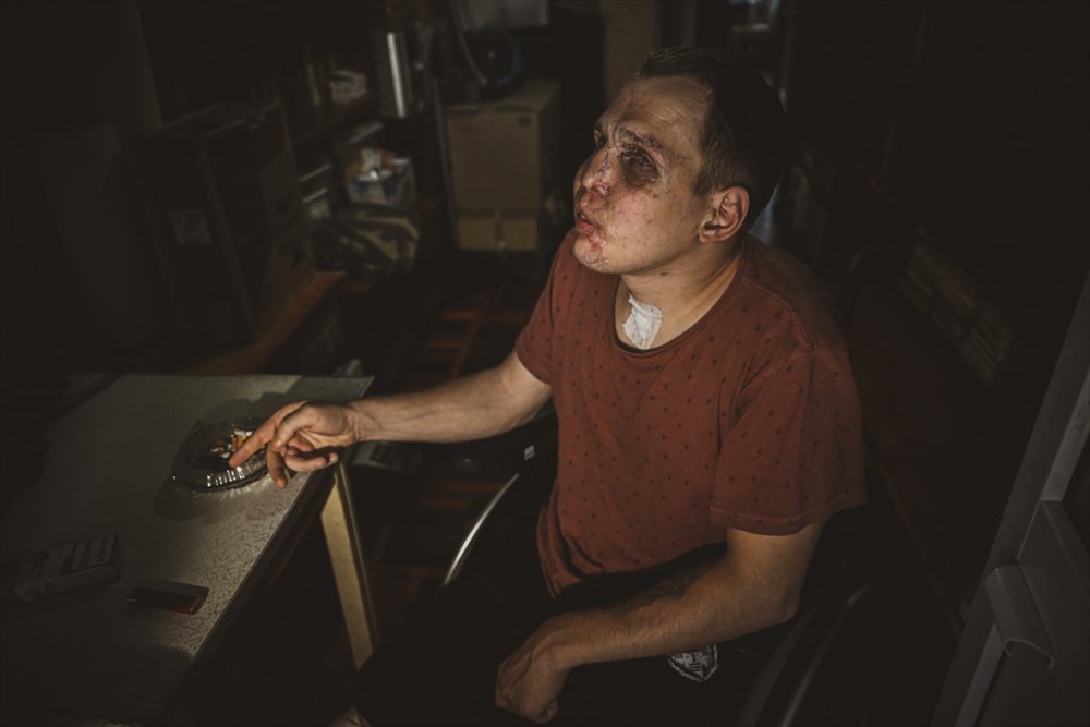 Ukrayna'daki savaşın acı yüzü: Gözlerini ve bacaklarını kaybeden Ukraynalı asker